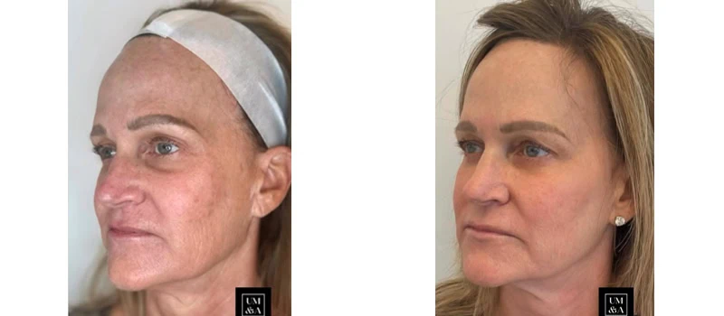 helix co2 laser rejuvenation