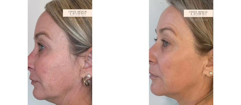 helix co2 laser rejuvenation