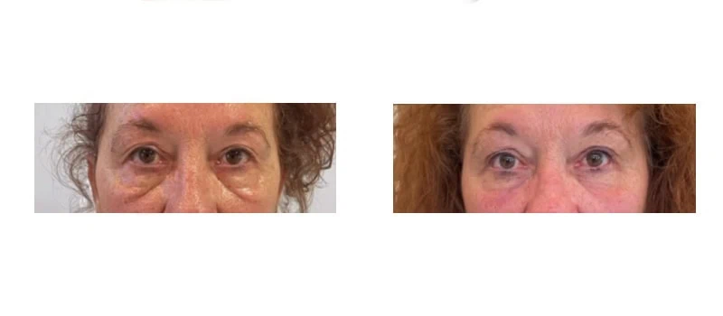 helix co2 laser rejuvenation