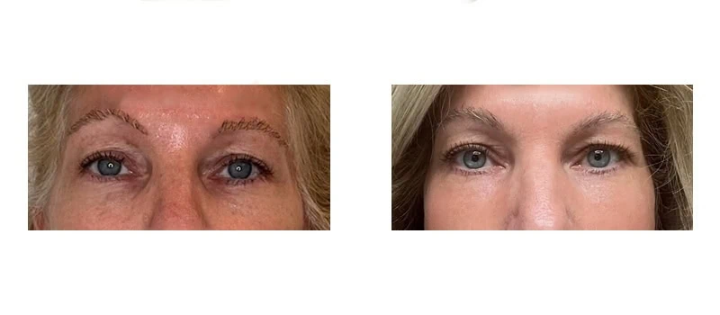 helix co2 laser rejuvenation