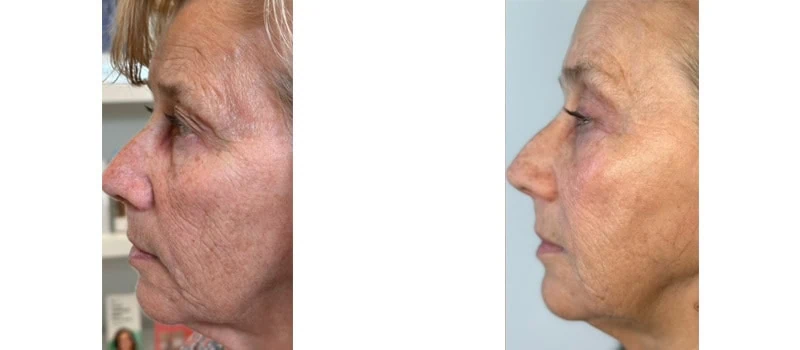 helix co2 laser rejuvenation