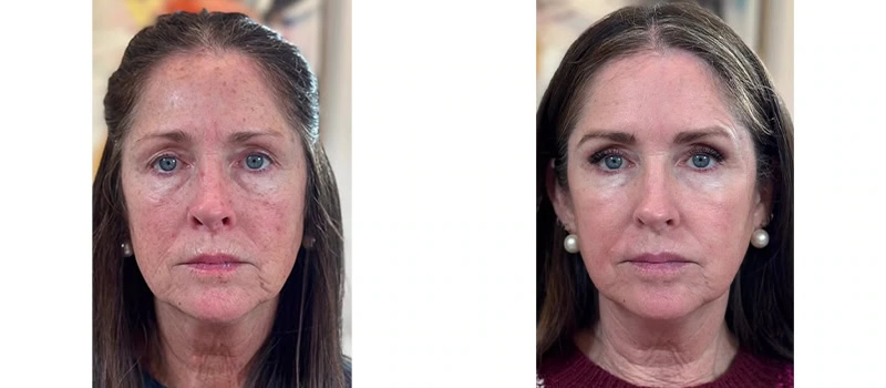 Co2 laser resurfacing