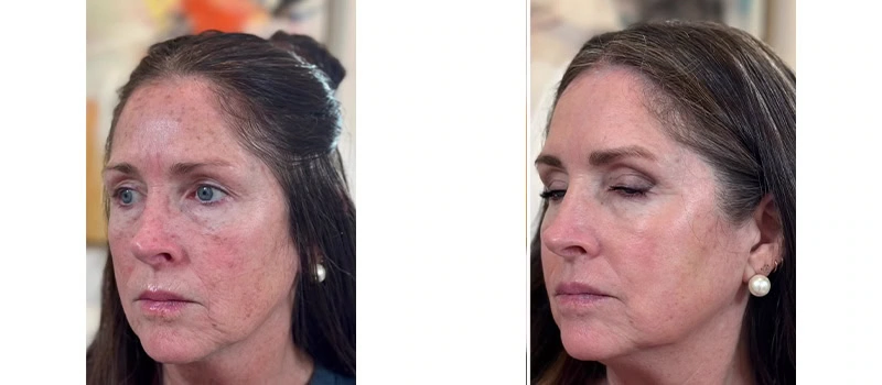 Co2 laser resurfacing