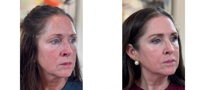 Co2 laser resurfacing