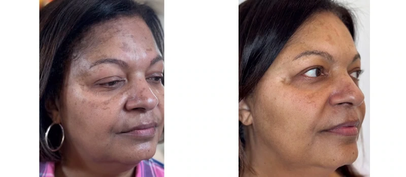 best fillers for face