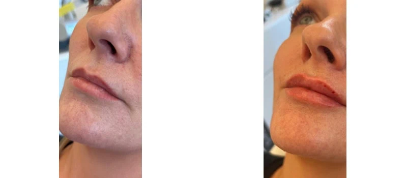lip fillers