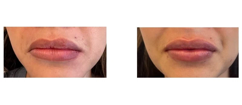 Revanesse Lips Services United Medical and Aesthetics