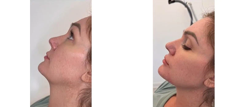 dermal filler in cheeks