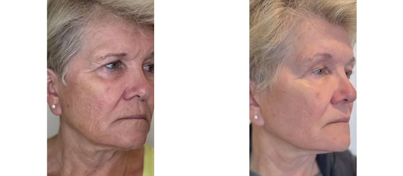 micro needling