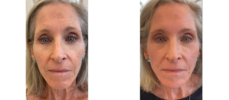 dermal fillers