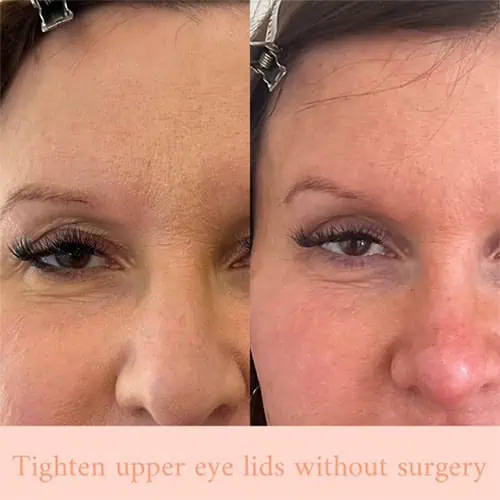 Subnail in Wilmington, NC | United Medical And Aesthetics