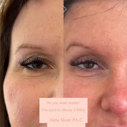 Subnail in Wilmington, NC | United Medical And Aesthetics