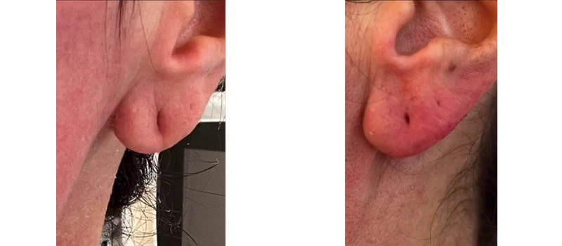 laser skin resurfacing