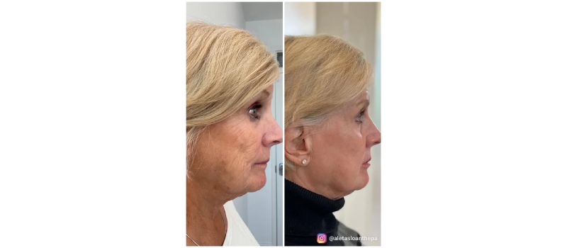 Co2 laser resurfacing