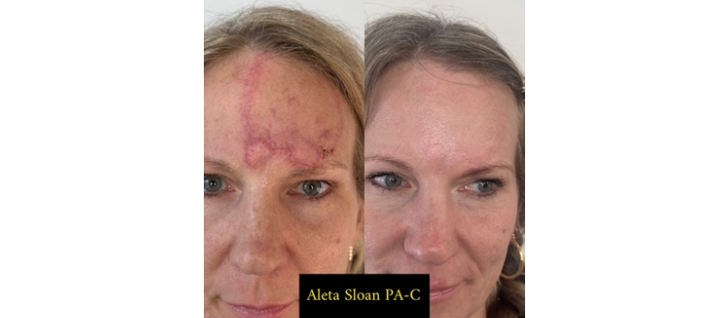 Co2 laser resurfacing