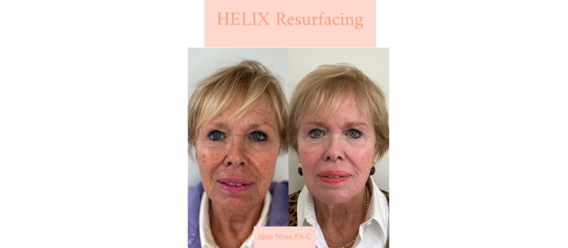 Co2 laser resurfacing