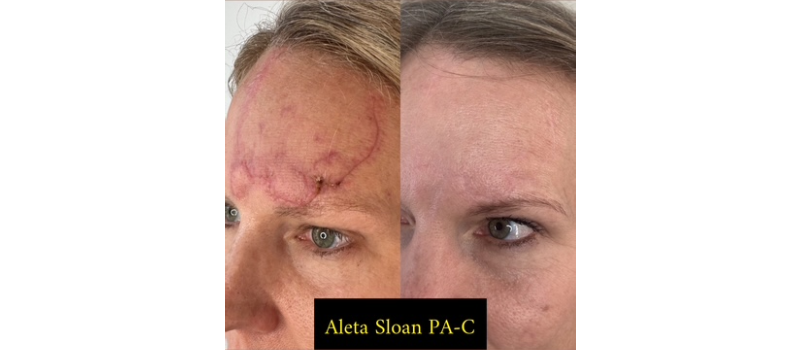 Co2 laser resurfacing