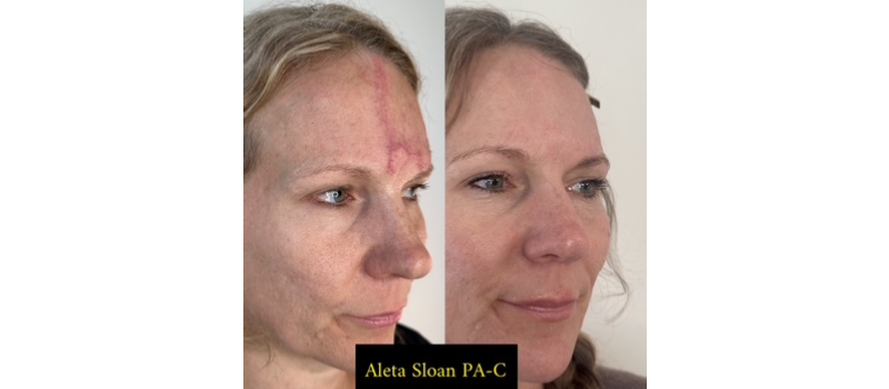 Co2 laser resurfacing