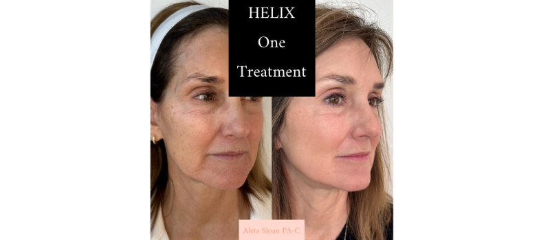 Co2 laser resurfacing