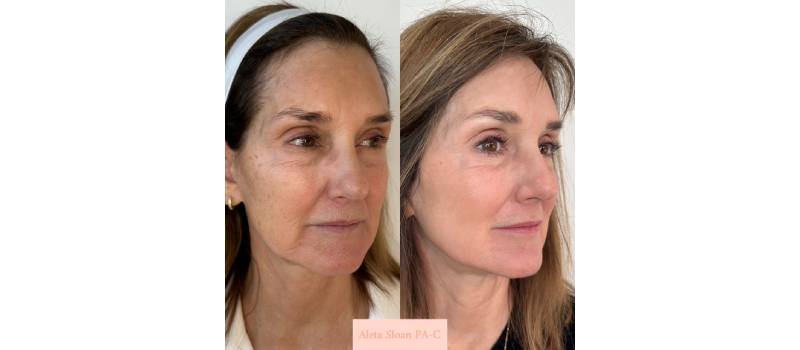Co2 laser resurfacing