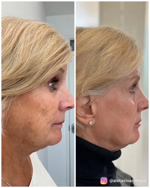 Co2 laser resurfacing