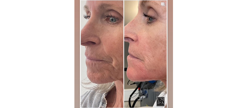 dermal filler injections