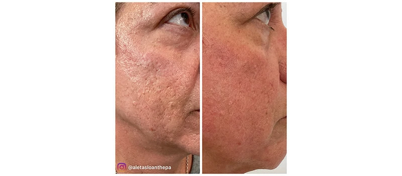 HELIX CO2 Laser Rejuvenation in Wilmington, NC | United Medical And Aesthetics