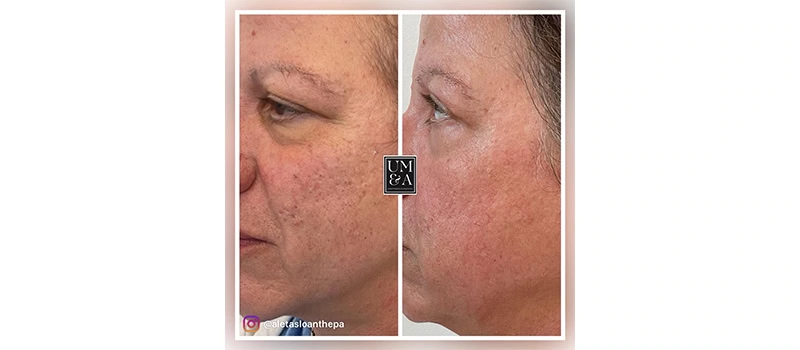 HELIX CO2 Laser Rejuvenation in Wilmington, NC