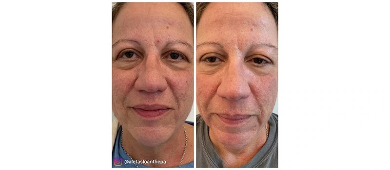 HELIX CO2 Laser Rejuvenation in Wilmington, NC | United Medical And Aesthetics