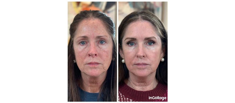 HELIX CO2 Laser Rejuvenation in Wilmington, NC