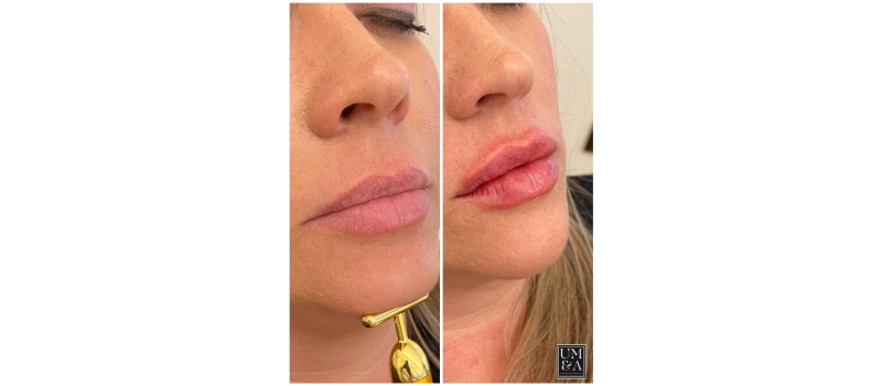 Lip Fillers