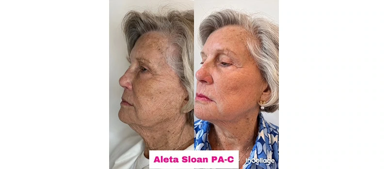 microneedling facial