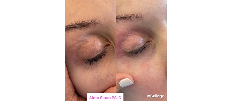dermal filler injections