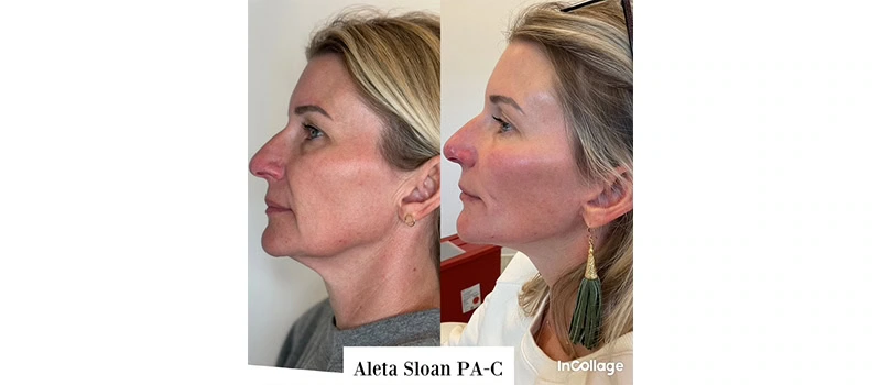 Botox wilmington nc