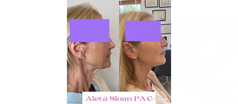 microneedling facial