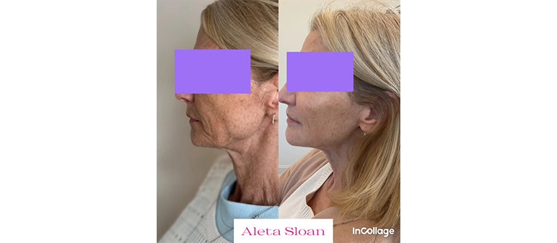 Botox wilmington nc
