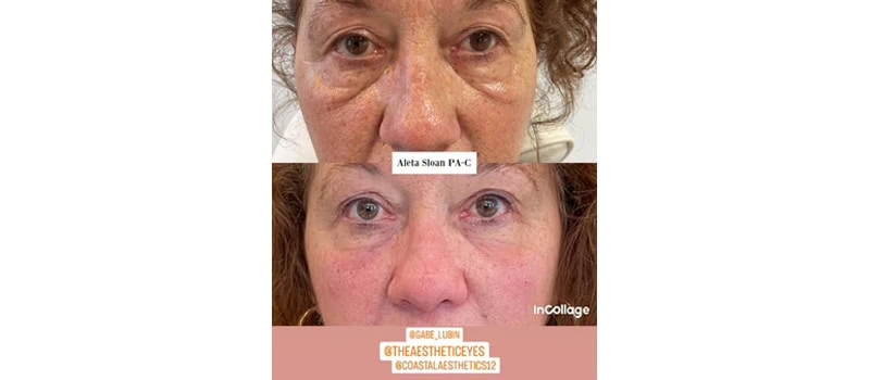 microneedling facial