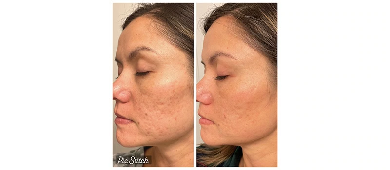 Co2 laser resurfacing