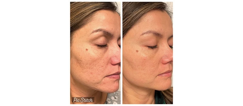 Co2 laser resurfacing