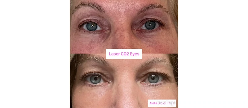 Co2 laser resurfacing