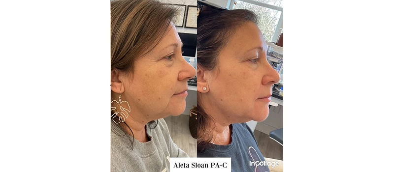 dermal fillers