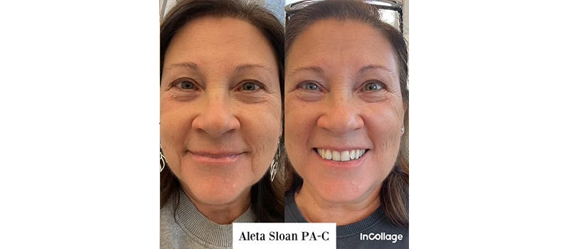 dermal fillers