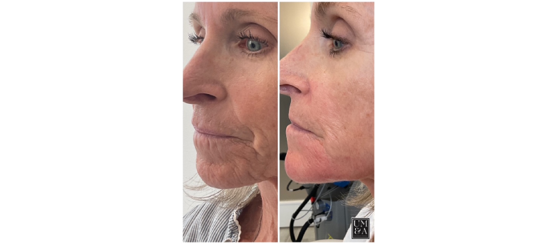 dermal filler injections
