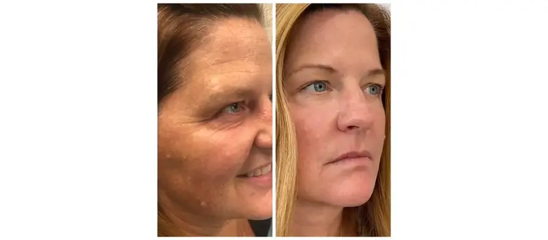 Skin Rejuvenation in Wilmington, NC | United Medical And Aesthetics