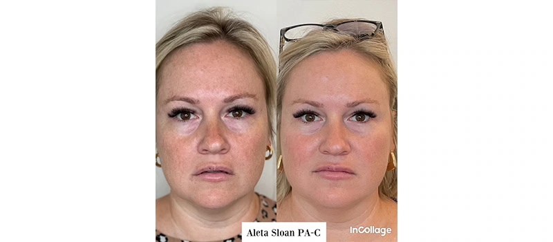 Botox wilmington nc