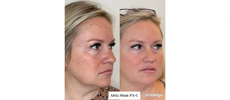 Botox wilmington nc