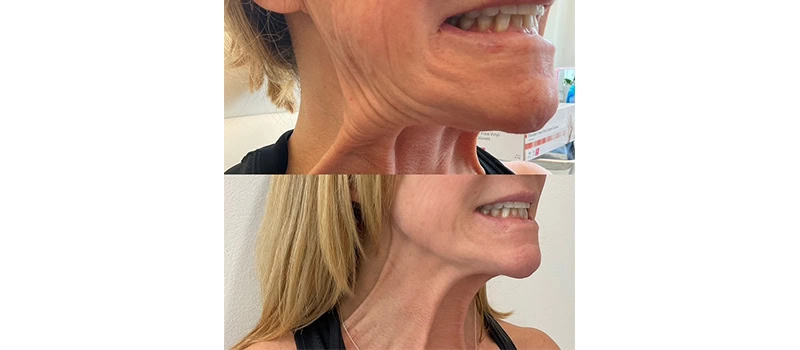 Neuromodulators in Wilmington, NC | United Medical And Aesthetics