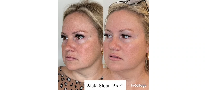 Botox wilmington nc