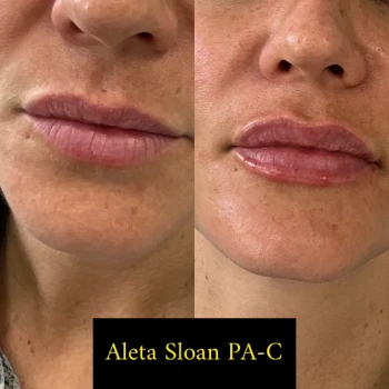 Lips B&A - a