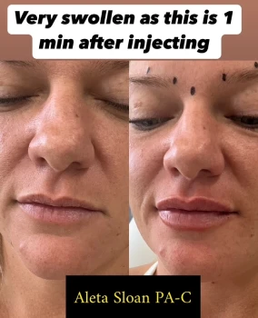 Lips B&A - b
